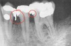 Complimentary Overhang Filling Removal – Provided by Dental Hygiene Students Under Dentist & RDH Supervision