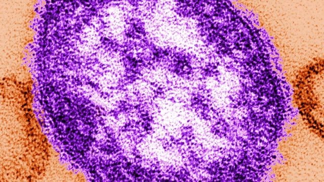 Measles outbreak declared in Snohomish County as 3 local children test positive