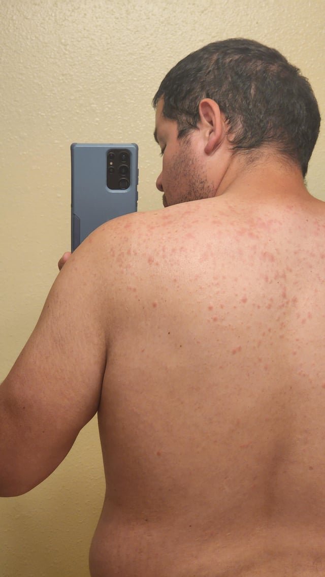 Rash after being in Lake Washington.
